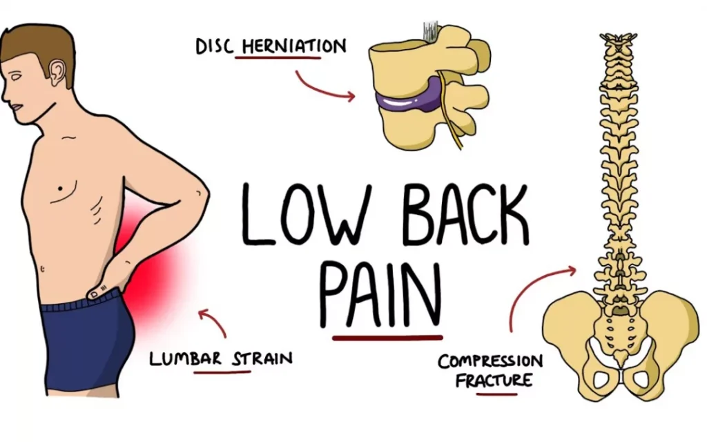 All Reasons for Low Back Pain