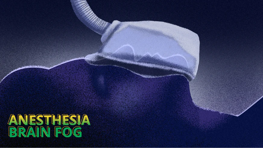 How Long Does Brain Fog Last After Anesthesia