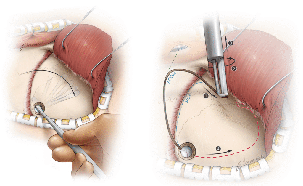 Burr Hole Surgery Success Rate
