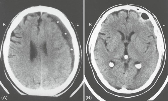 Epidural vs Subdural Hematoma