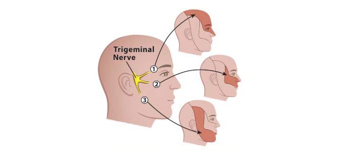 Trigeminal Neuralgia