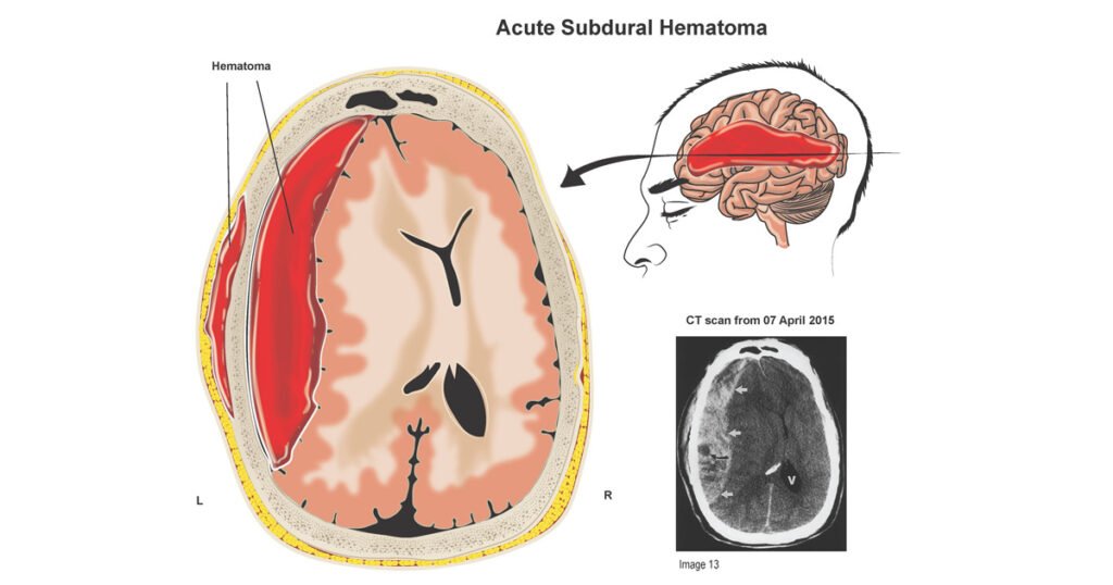Subdural Hematoma