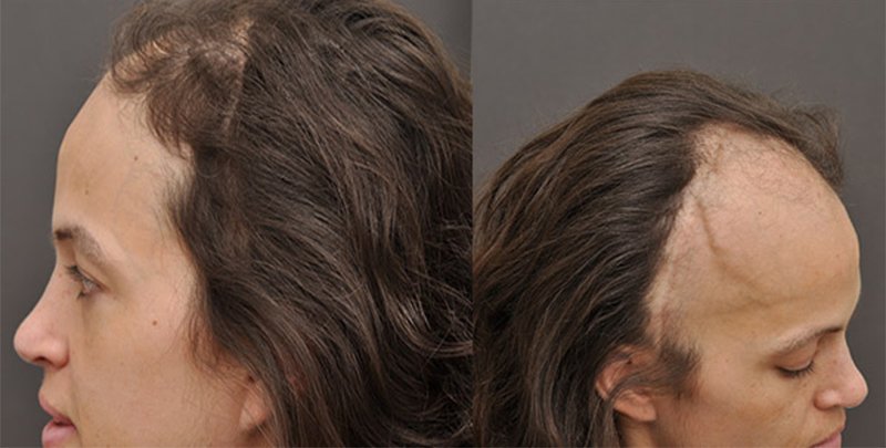 can a brain tumor cause hair loss