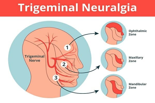 trigeminal neuralgia specialists​