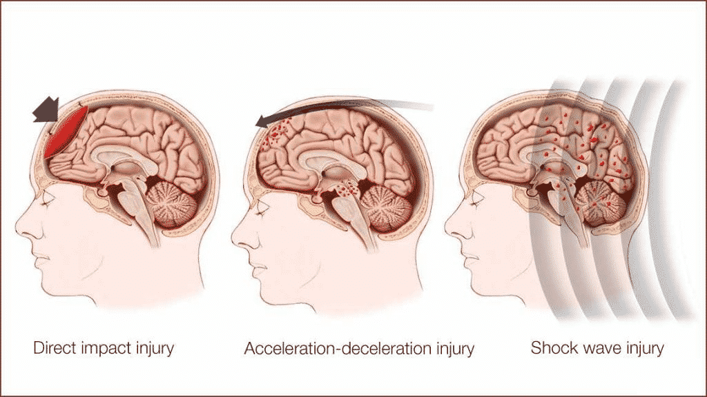 How Is the Brain Protected from Injury and Shock