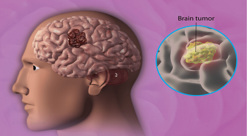 brain tumor treatment without surgery in india​

