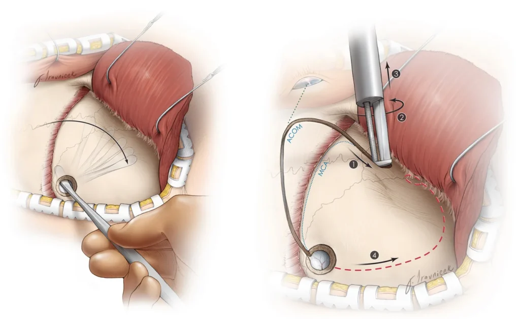 Burr Hole Surgery Recovery Timeline