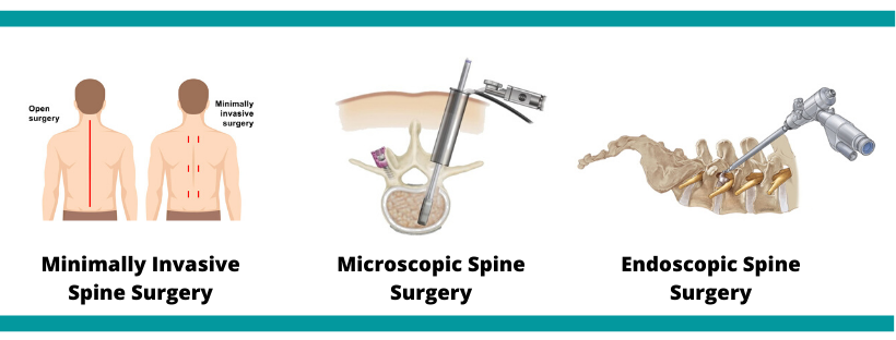 MINIMALLY INVASIVE SPINE SURGERY