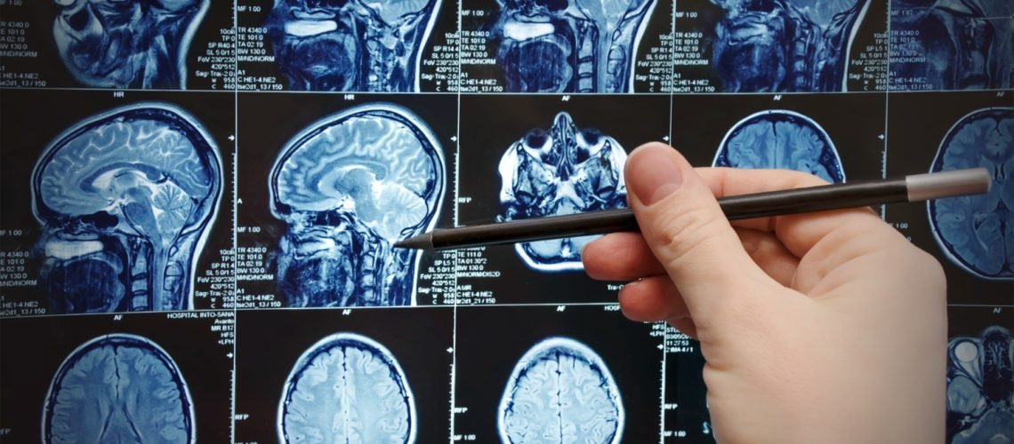 magnetic-resonance-image-brain-mri-survey